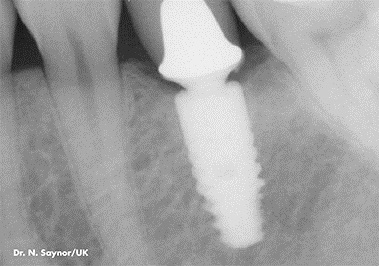 X-ray of the total reconstruction of the tooth, Gdansk-Poland