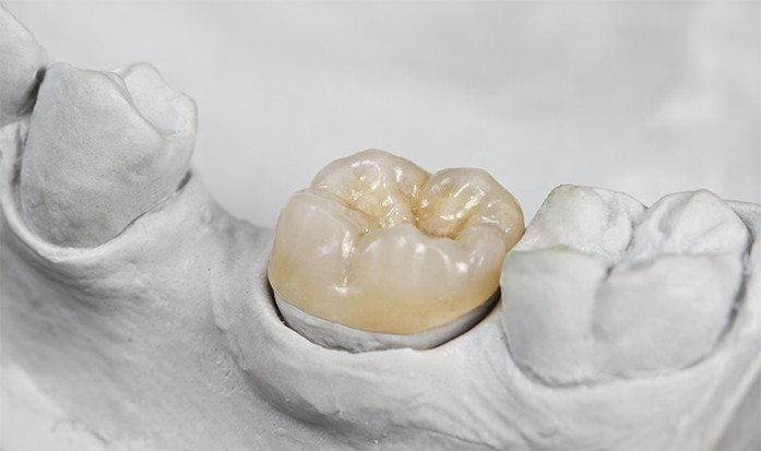 Fillings ( inlay, onlay ) dental treatment Poland Gdansk
